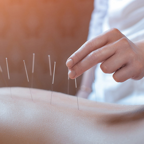 Acupuncture